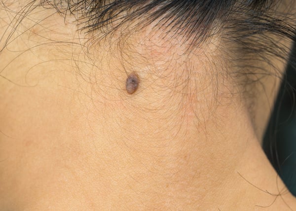 Black-mole-on-the-back-neck-skin-of-Asian-woman-with-skin-cancer