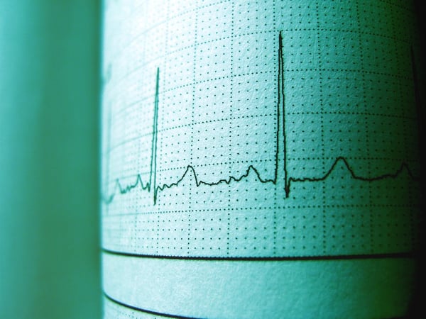 heart attack ECG thailand