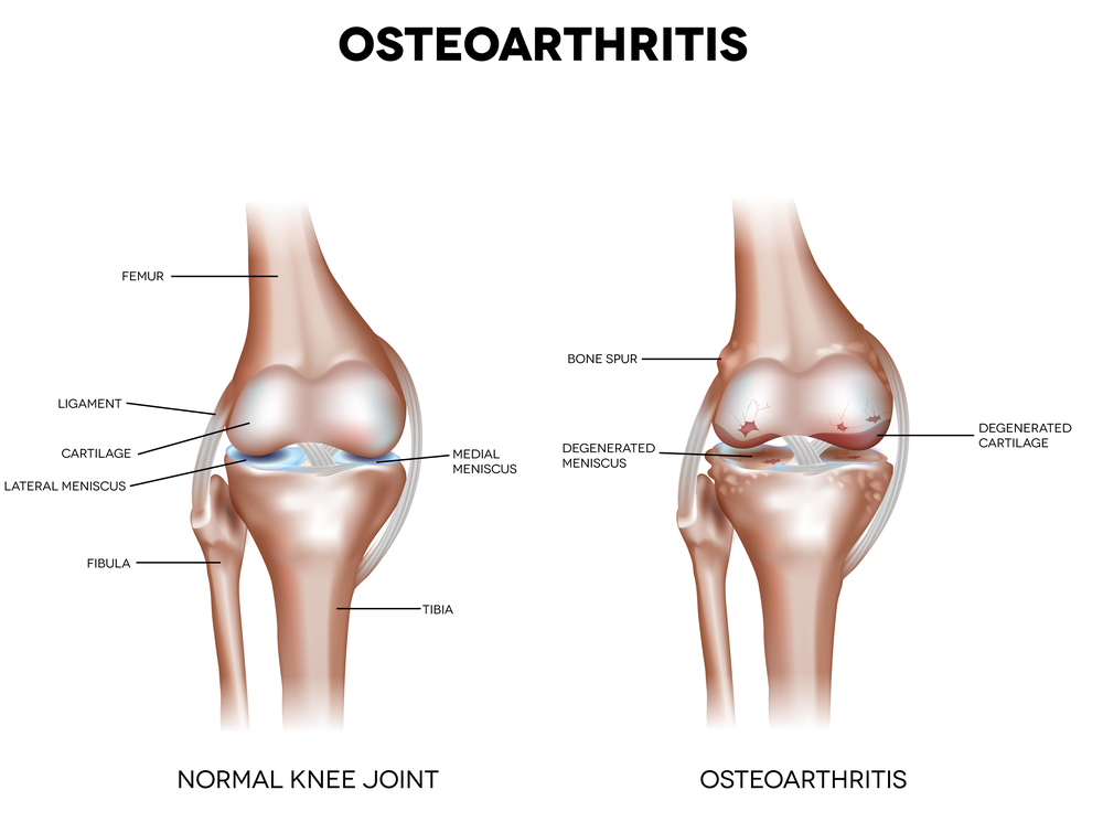 Osteoarthritis